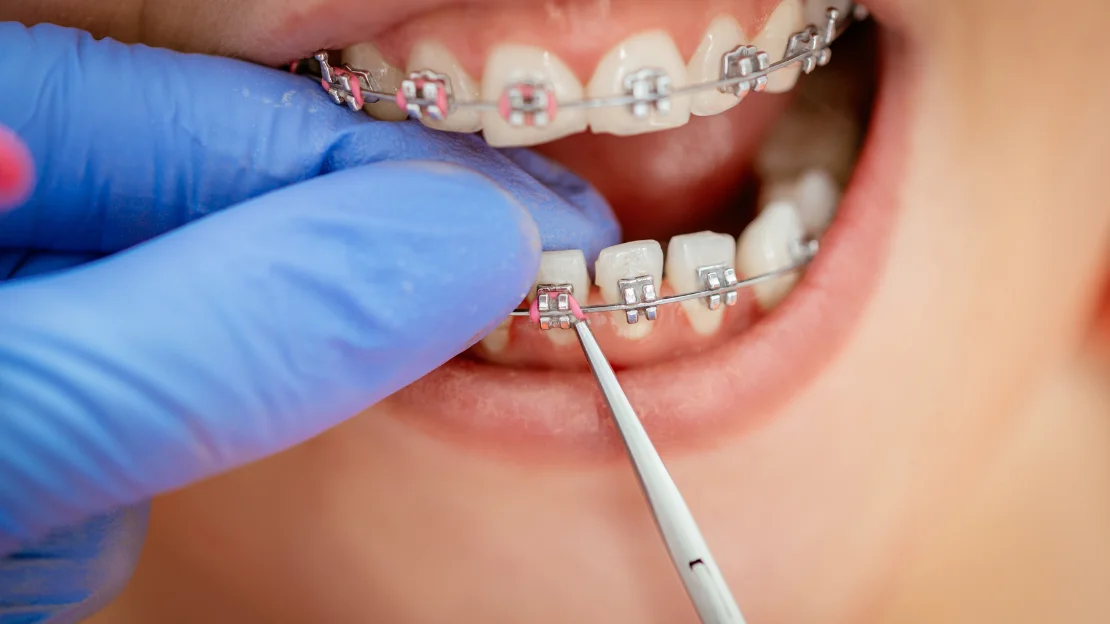 Close-up of orthodontist in blue gloves adjusting metal braces on a patient's teeth with a tool