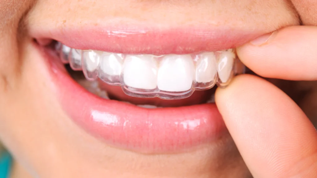 Close-up of a person inserting a clear aligner tray onto their upper teeth