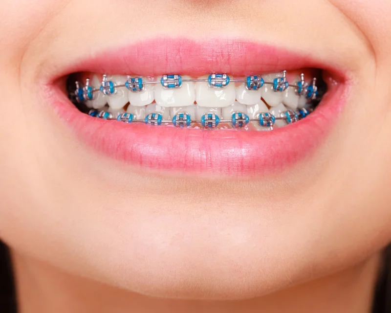 Close-up of smiling mouth with metal braces and blue elastic bands on teeth